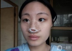 鼻子塌了，鼻子寬了，臉看起來扁扁的，不立體，一直想要個高鼻子