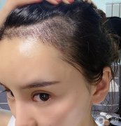 種植發(fā)際線3天了，現(xiàn)在好像種植面積挺密集的，第一天就紅下去了