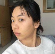 線雕完第七天了，現(xiàn)在臉上的針眼還看得見(jiàn)，但是結(jié)痂了