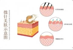 微針調節(jié)間隔時間的醫(yī)美知識