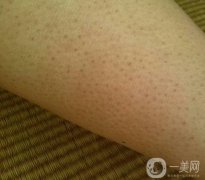 擺脫“雞皮膚”：理解、預(yù)防與調(diào)節(jié)