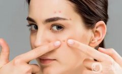 明星也逃不過(guò)痘痘的困擾，解析痘痘類(lèi)型及預(yù)防方法