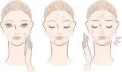 玫瑰痤瘡與脂溢性皮炎：誤診與科學(xué)護理