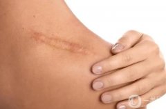 阿嬌傷勢(shì)恢復(fù)，淡化疤痕有妙招!從成因找方法，讓疤痕無(wú)跡可痕