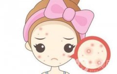 痘痘肌的福音!揭秘致痘成分，讓你遠(yuǎn)離痘痘困擾