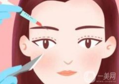 保定雙眼皮多少錢？埋線好還是割好？