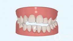 常德矯正牙齒一般多少錢？?jī)r(jià)目表2024版，靠譜醫(yī)院推薦