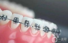 巴南區(qū)牙齒矯正費(fèi)用多少錢？正畸這五點(diǎn)你不得不知道