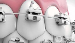 潮州牙齒矯正多少錢？收費(fèi)標(biāo)準(zhǔn)解答，附牙科機(jī)構(gòu)預(yù)選！