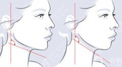 削顴骨要多少錢？全新價格費(fèi)用揭曉，機(jī)構(gòu)一鍵了解