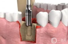 珠海種植牙價格表2024全新公布！植牙機構(gòu)+步驟一文全解析