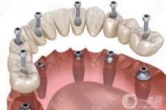 三亞種一顆牙多少錢？種植牙步驟和階段時間一文解答