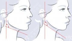 磨骨下頜角要多少錢？下頜角磨骨手術(shù)步驟、醫(yī)院這里了解！