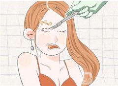全切雙眼皮手術后多久可以拆線