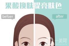 什么是果酸換膚，有什么功效