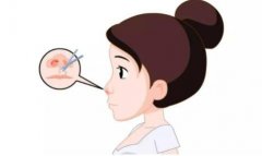 如何鼻整形手術(shù)的安全？