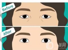 雙眼皮是如何割的？割的過深該怎么辦