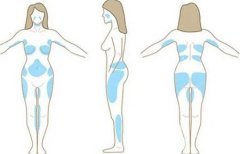 什是吸脂縮小乳房，效果怎么樣？