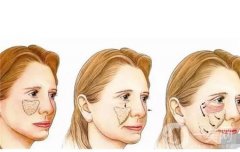 自體脂肪填充會(huì)凹凸不平嗎