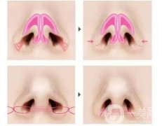 注射玻尿酸隆鼻會導致新陳代謝過快嗎？