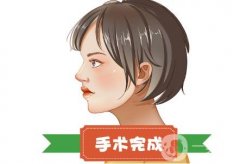 鼻小柱延長(zhǎng)手術(shù)會(huì)否導(dǎo)致塌陷？