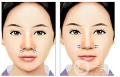 鼻部整形有什么后遺癥