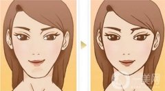 墊下巴的材料選擇及術后護理