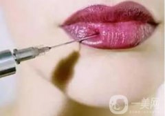 嘟嘟唇注射后有哪些注意事項