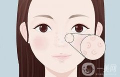 光子嫩膚的生物刺激作用效果怎么樣？