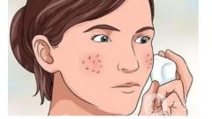 紅藍光痤瘡有什么優(yōu)勢