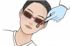 激光黑眼圈后的恢復期長嗎