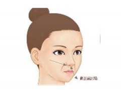 矯正鷹鉤鼻手術(shù)的效果如何呢？