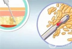 手臂抽脂的效果怎么樣