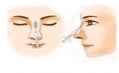 鼻孔縮小手術(shù)有哪些好處