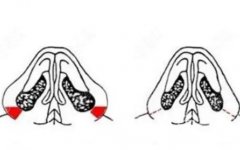 鼻頭縮小的方法和注意事項