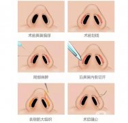 鼻孔縮小手術有哪些好處