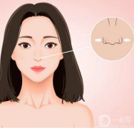 鼻孔縮小手術是否安全？是否有風險