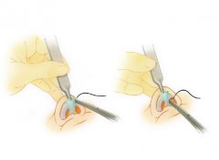 鼻尖矯正手術方法和步驟