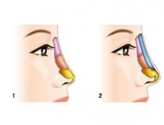 鼻部綜合手術后的感染癥狀
