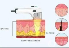 超聲刀是否會(huì)激發(fā)膠原蛋白呢？