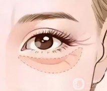 超聲波去眼袋是否有效，有什么副作用