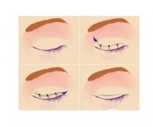 不同方式做雙眼皮的費(fèi)用