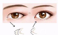 雙眼皮疤痕修復(fù)后的注意事項(xiàng)