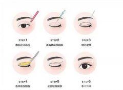 雙眼皮手術(shù)后失敗是情況有哪些？