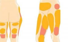 水動(dòng)力吸脂如何？是否會(huì)導(dǎo)致皮膚松弛呢