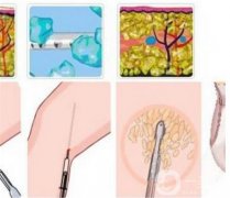 小腿吸脂后痛嗎，多久能恢復呢？