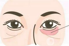 眼袋手術(shù)是否存在風(fēng)險(xiǎn)，具體有哪些方式呢？