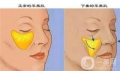 自體脂肪填充后面立即洗臉的危害是什么