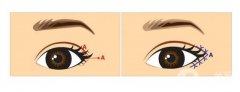 開(kāi)大內(nèi)眼角手術(shù)的方法與特點(diǎn)