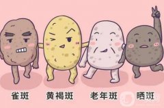 雷射美白祛斑的注意事項(xiàng)